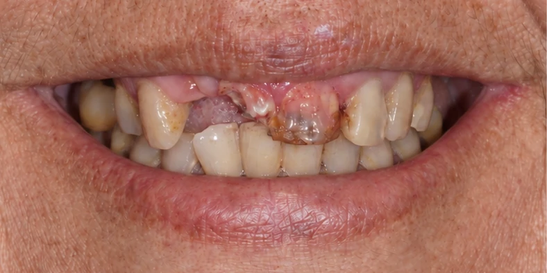 Antes: piezas frontales fracturadas y con caries.