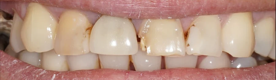 Antes: desgaste y restauraciones antiguas.
