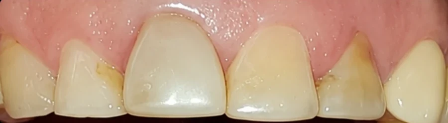 Antes: desgaste y pérdida de estructura.